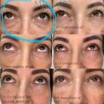 A woman 's eyes are shown with different stages of the same eye.