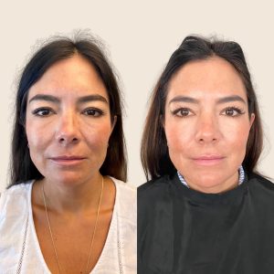 A before and after picture of a woman 's face.