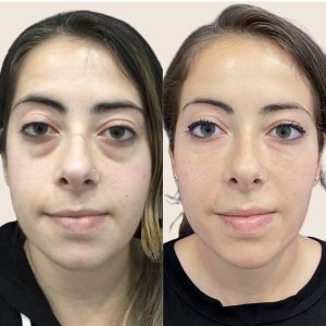 A before and after picture of a woman 's eyes.