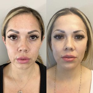 A before and after picture of a woman 's face.