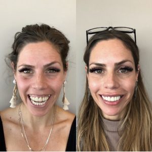 A before and after picture of a woman 's teeth.