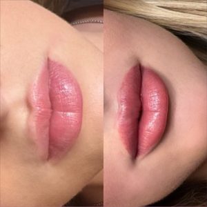 A before and after picture of the lips